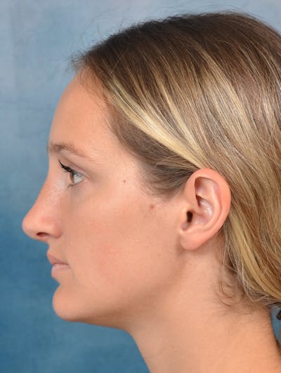 Rhinoplasty Before & After Gallery - Patient 143289390 - Image 2