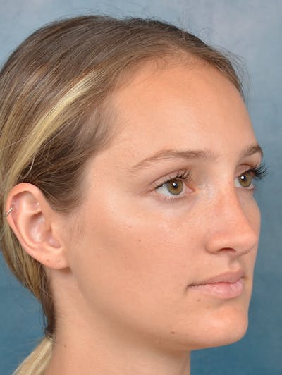 Rhinoplasty Before & After Gallery - Patient 143289390 - Image 8