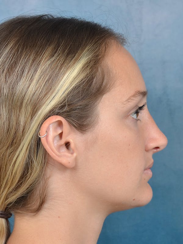 Rhinoplasty Before & After Gallery - Patient 143289390 - Image 10