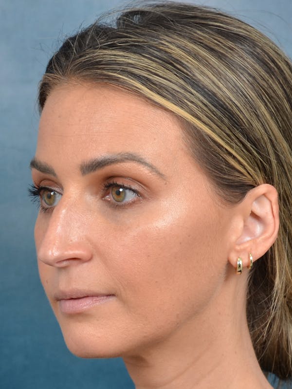 Rhinoplasty Before & After Gallery - Patient 143289480 - Image 3