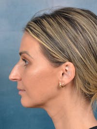 Rhinoplasty Before & After Gallery - Patient 143289480 - Image 1