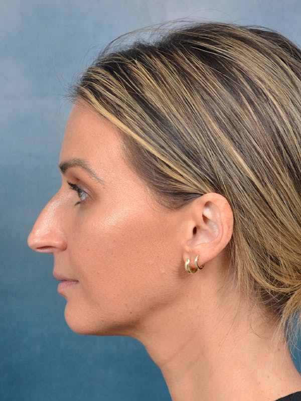 Rhinoplasty Before & After Gallery - Patient 143289480 - Image 1