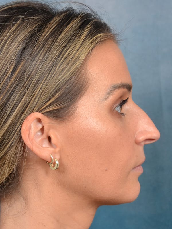 Rhinoplasty Before & After Gallery - Patient 143289480 - Image 9