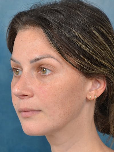 Rhinoplasty Before & After Gallery - Patient 143289480 - Image 4