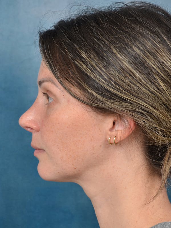 Rhinoplasty Before & After Gallery - Patient 143289480 - Image 2