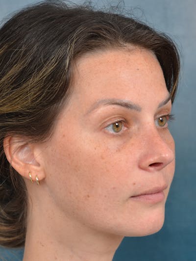 Rhinoplasty Before & After Gallery - Patient 143289480 - Image 8