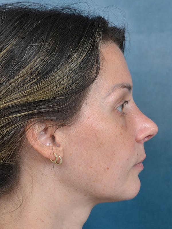 Rhinoplasty Before & After Gallery - Patient 143289480 - Image 10