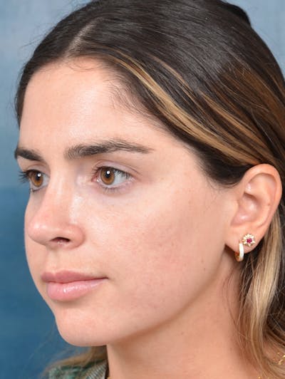 Rhinoplasty Before & After Gallery - Patient 143289517 - Image 4