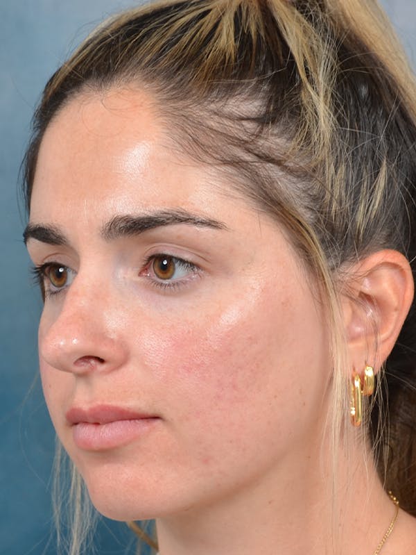 Rhinoplasty Before & After Gallery - Patient 143289517 - Image 3