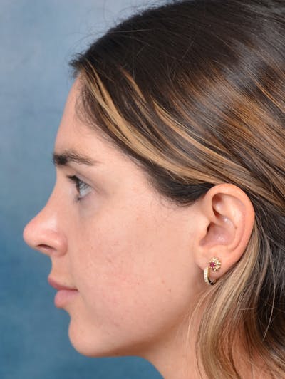 Rhinoplasty Before & After Gallery - Patient 143289517 - Image 2