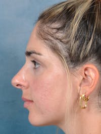Rhinoplasty Before & After Gallery - Patient 143289517 - Image 1