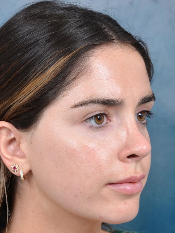 Rhinoplasty Before & After Gallery - Patient 143289517 - Image 8