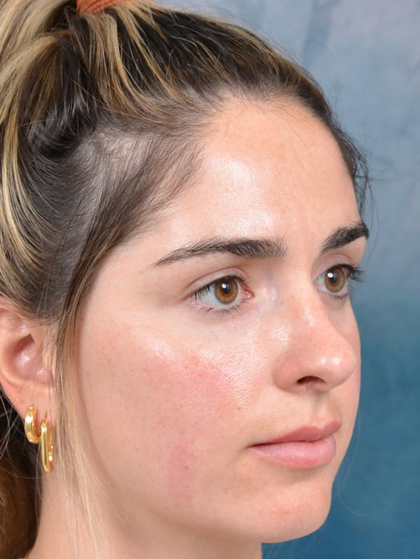 Rhinoplasty Before & After Gallery - Patient 143289517 - Image 7