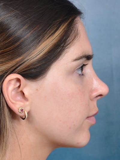 Rhinoplasty Before & After Gallery - Patient 143289517 - Image 10
