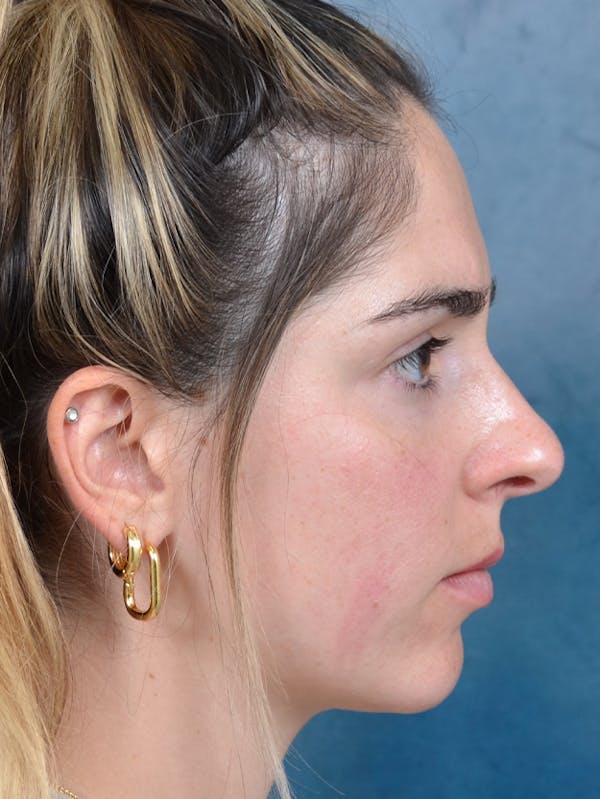 Rhinoplasty Before & After Gallery - Patient 143289517 - Image 9