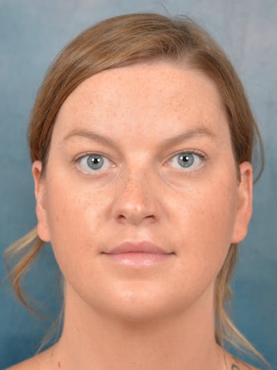 Deep Neck Lift Before & After Gallery - Patient 141524227 - Image 1