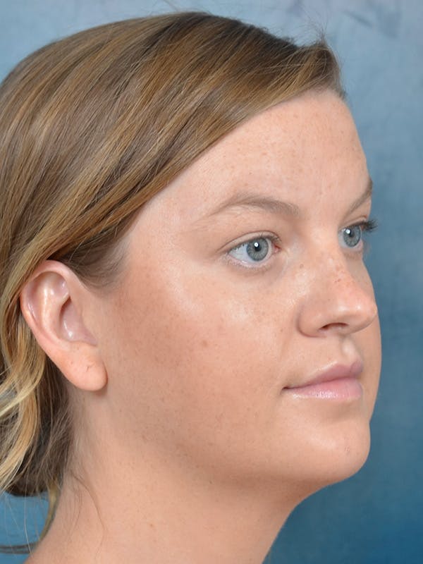Rhinoplasty Before & After Gallery - Patient 143507932 - Image 5