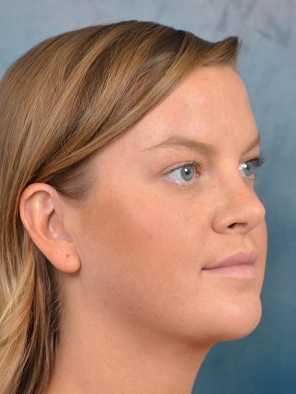 Rhinoplasty Before & After Gallery - Patient 143507932 - Image 6