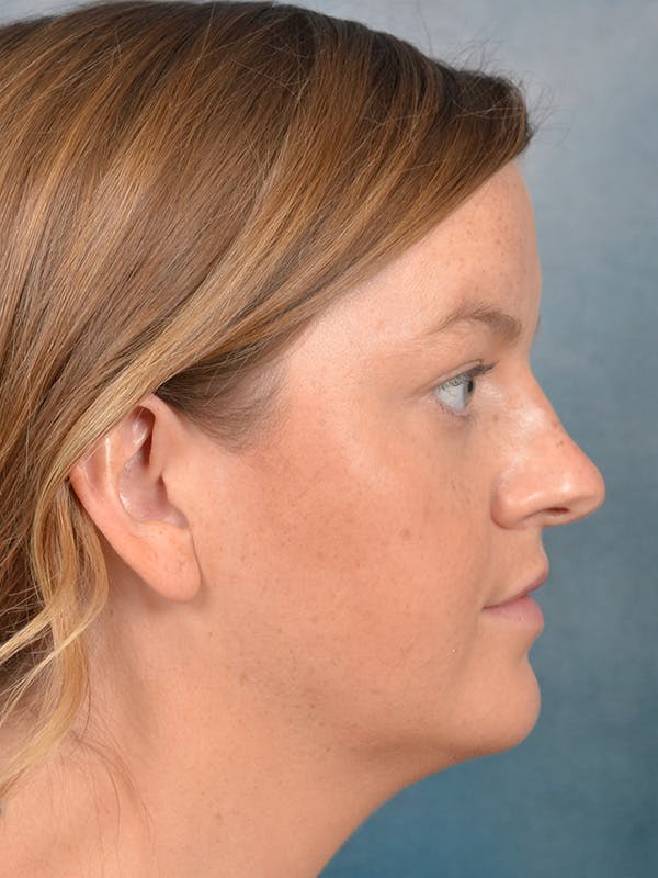 Rhinoplasty Before & After Gallery - Patient 143507932 - Image 7