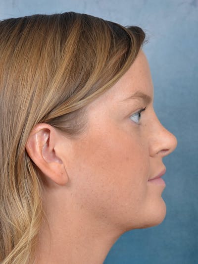 Rhinoplasty Before & After Gallery - Patient 143507932 - Image 8