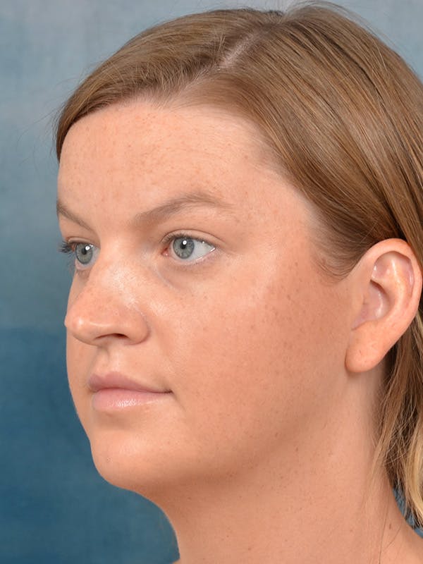 Rhinoplasty Before & After Gallery - Patient 143507932 - Image 9