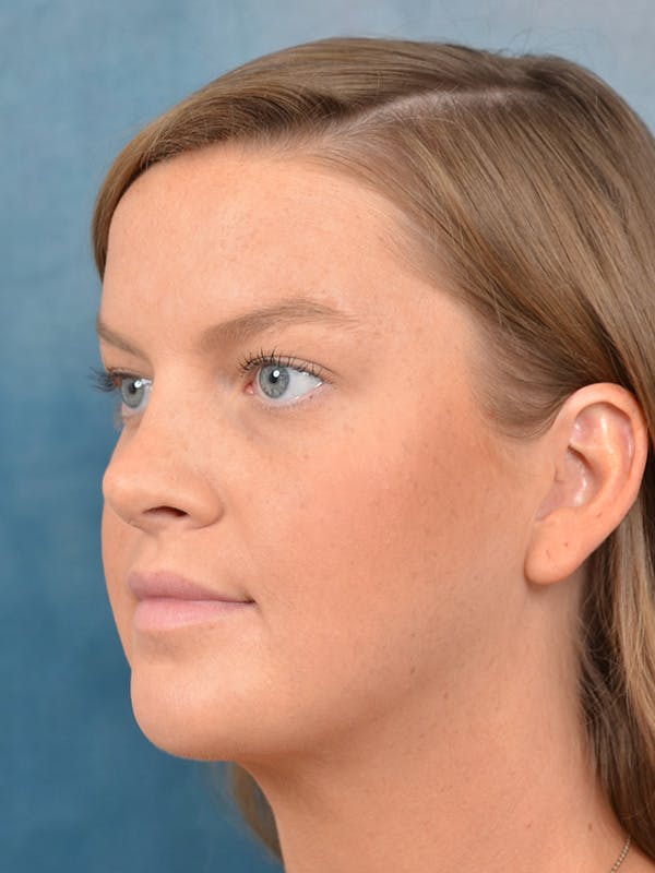 Deep Neck Lift Before & After Gallery - Patient 141524227 - Image 8