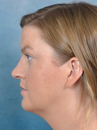Rhinoplasty Before & After Gallery - Patient 143507932 - Image 1