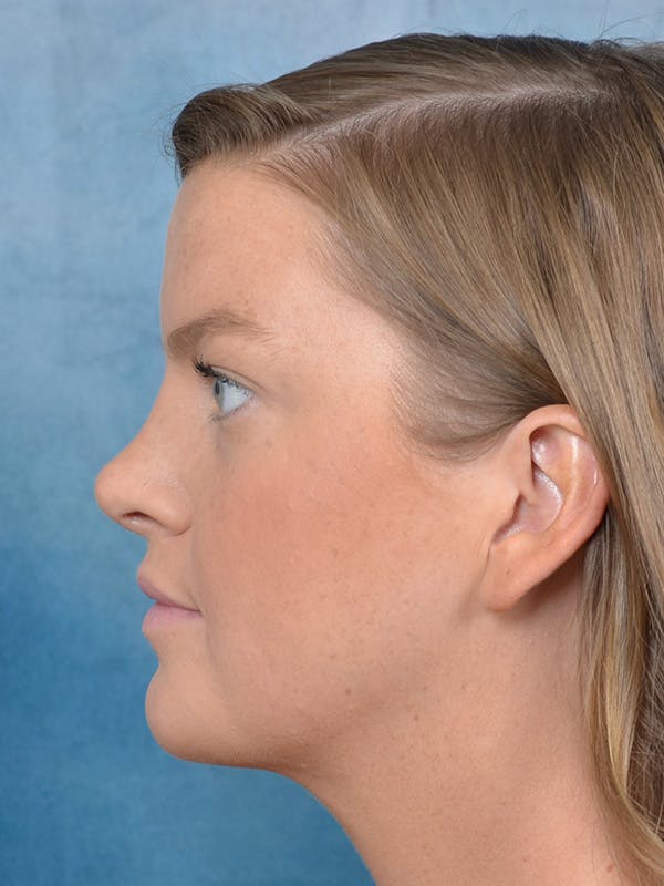 Rhinoplasty Before & After Gallery - Patient 143507932 - Image 2