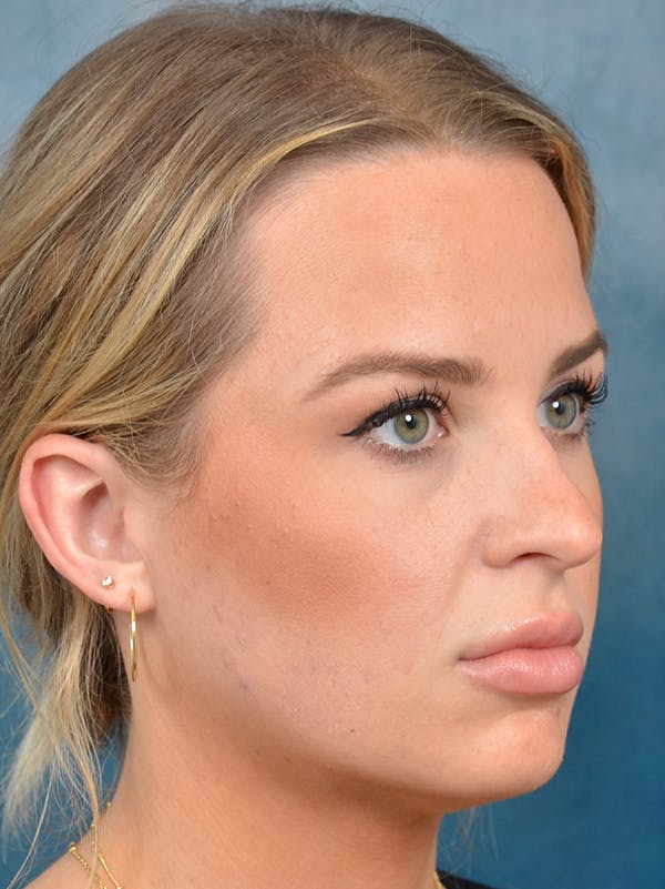 Rhinoplasty Before & After Gallery - Patient 143507938 - Image 5
