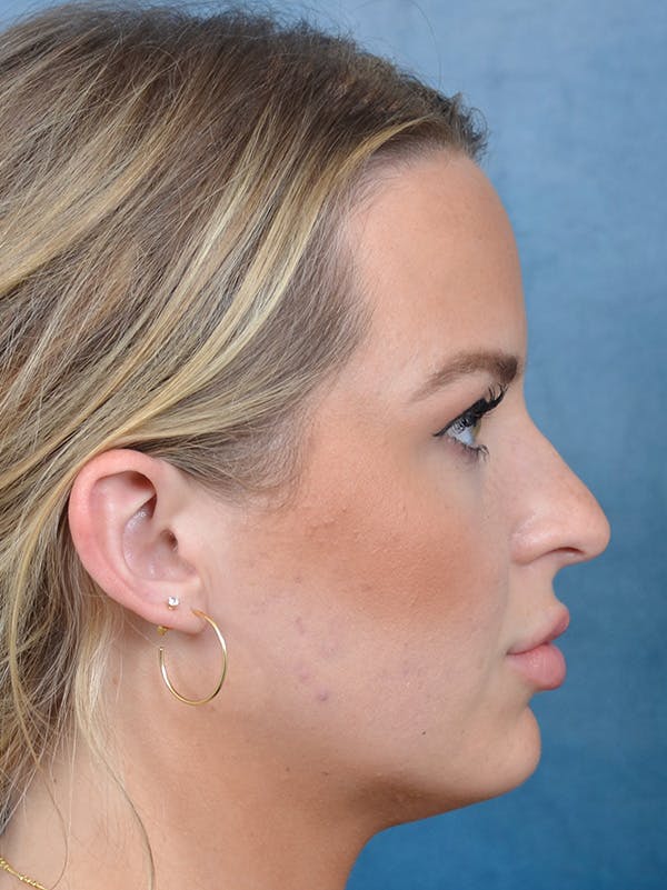 Rhinoplasty Before & After Gallery - Patient 143507938 - Image 7