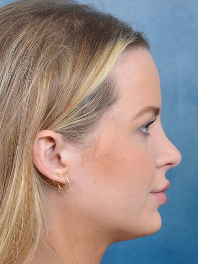Rhinoplasty Before & After Gallery - Patient 143507938 - Image 8