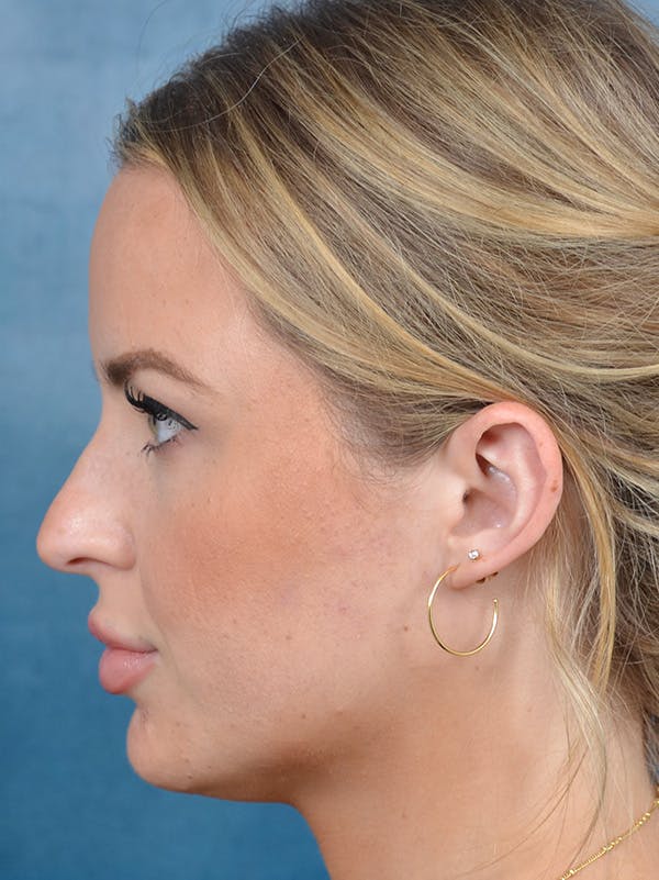 Rhinoplasty Before & After Gallery - Patient 143507938 - Image 1