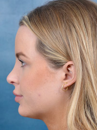 Rhinoplasty Before & After Gallery - Patient 143507938 - Image 2