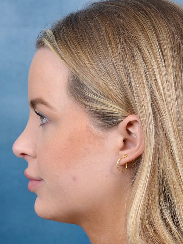 Rhinoplasty Before & After Gallery - Patient 143507938 - Image 2