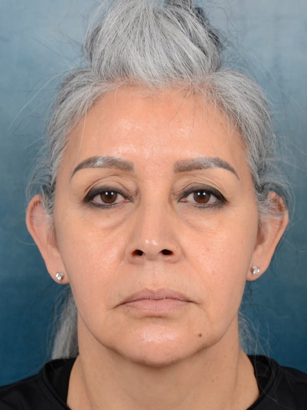 Deep Plane Facelift Before & After Gallery - Patient 143507939 - Image 3