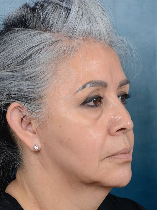 Brow Lift Before & After Gallery - Patient 143507940 - Image 3