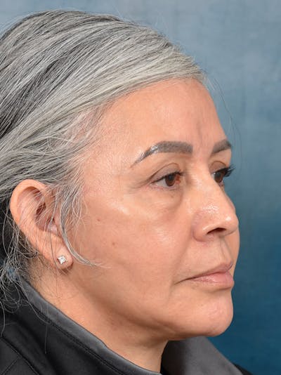 Brow Lift Before & After Gallery - Patient 143507940 - Image 4