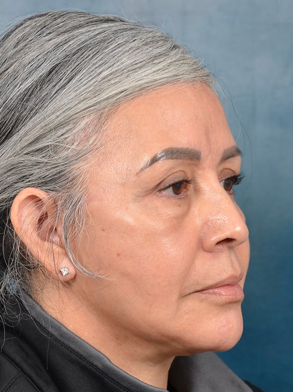 Eyelid Lift Before & After Gallery - Patient 143507941 - Image 4