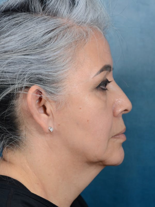 Deep Plane Facelift Before & After Gallery - Patient 143507939 - Image 7