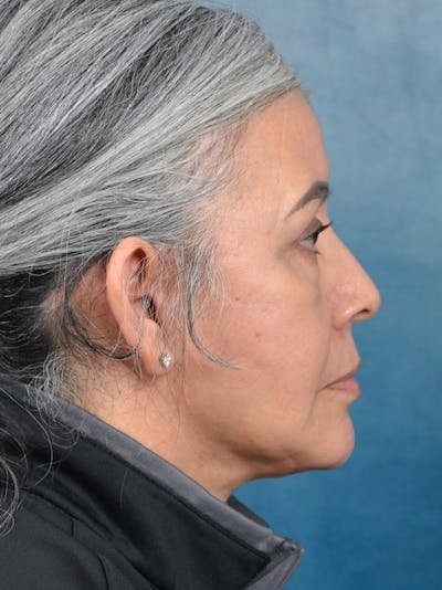 Deep Plane Facelift Before & After Gallery - Patient 143507939 - Image 6