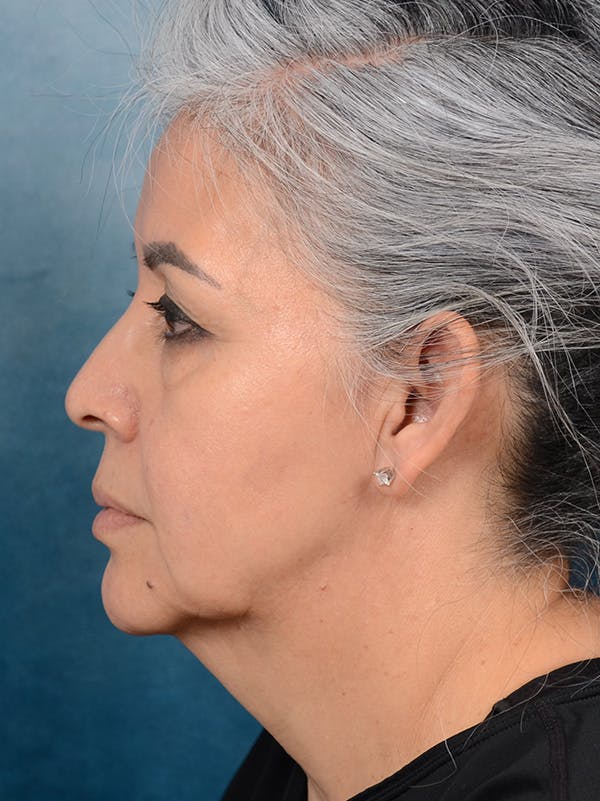Eyelid Lift Before & After Gallery - Patient 143507941 - Image 9