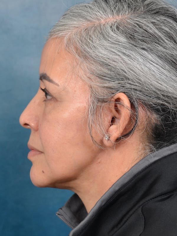 Deep Plane Facelift Before & After Gallery - Patient 143507939 - Image 10