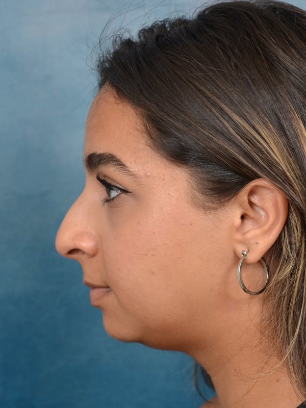 Rhinoplasty Before & After Gallery - Patient 144210398 - Image 1