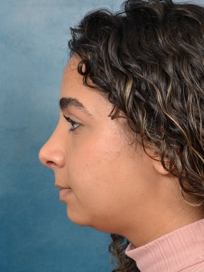 Rhinoplasty Before & After Gallery - Patient 144210398 - Image 2