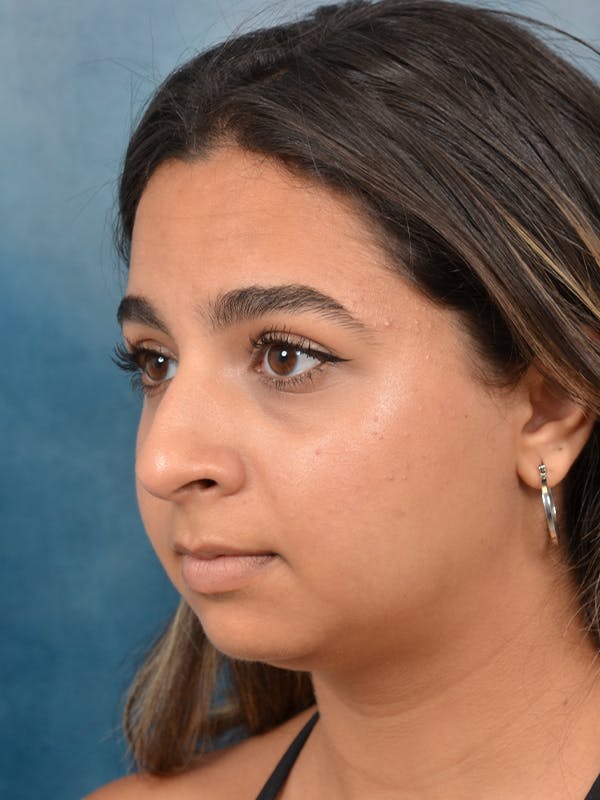 Rhinoplasty Before & After Gallery - Patient 144210398 - Image 5