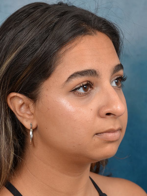 Rhinoplasty Before & After Gallery - Patient 144210398 - Image 7