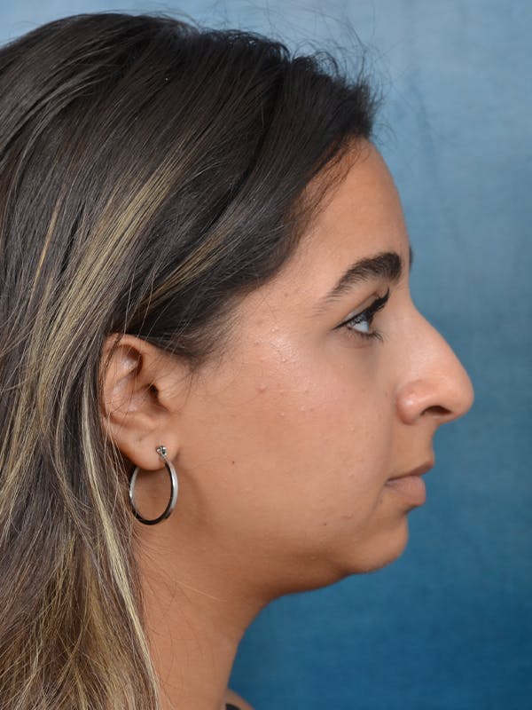 Rhinoplasty Before & After Gallery - Patient 144210398 - Image 9
