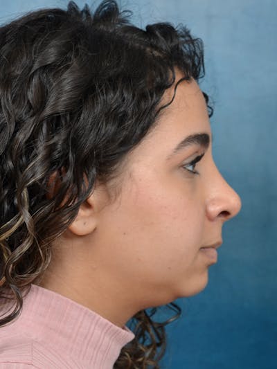 Rhinoplasty Before & After Gallery - Patient 144210398 - Image 10
