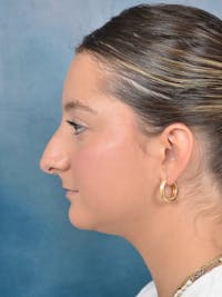 Rhinoplasty Before & After Gallery - Patient 144210399 - Image 1