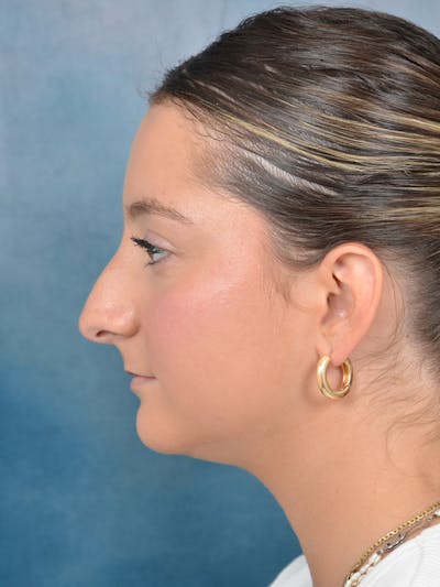 Rhinoplasty Before & After Gallery - Patient 144210399 - Image 1